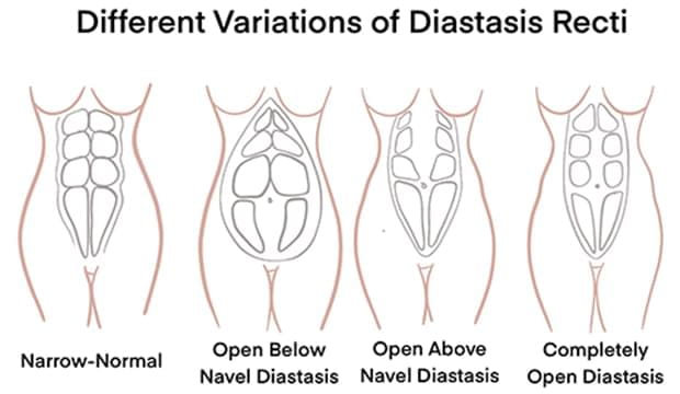 Different variation of diastasis recti.